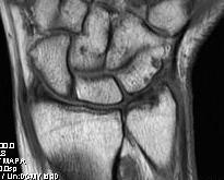 TFCC Degenerative Tear with Chondromalacia